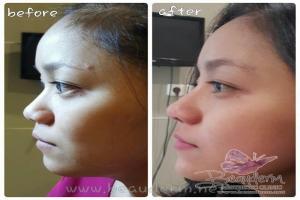 Filler Hidung / Nose Filler
