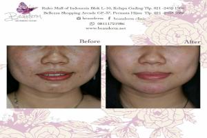 Chin Augmentation / Filler Dagu