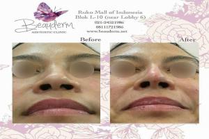 Filler Hidung / Nose Filler