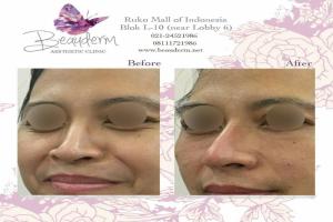 Smile Line Filler