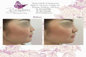 Filler Hidung / Nose Filler