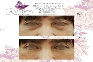 Under Eye Filler