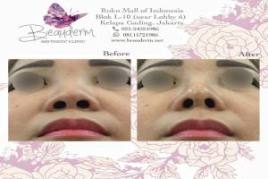 Filler Hidung / Nose Filler