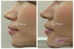 Filler Hidung / Nose Filler