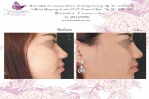 Filler Hidung / Nose Filler