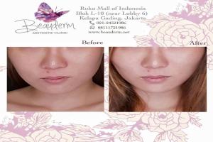 Tarik Benang (Threadlift)