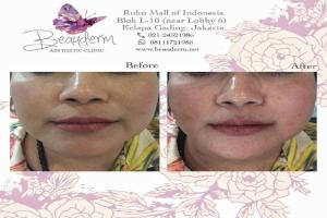 Tarik Benang (Threadlift)