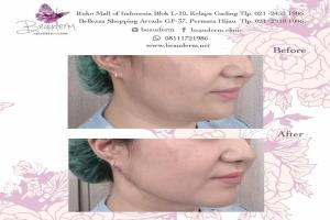 Chin Augmentation / Filler Dagu