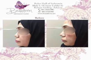 Tarik Benang (Threadlift)