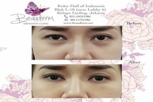 Under Eye Filler
