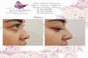 Filler Hidung / Nose Filler