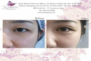 Double Eyelid Stitching