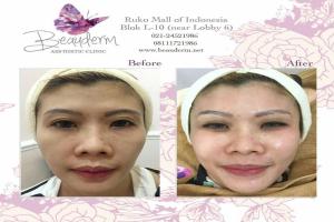 Skin Rejuvenation / Peremajaan Kulit