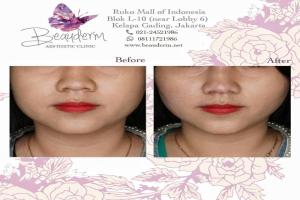 Tarik Benang (Threadlift)