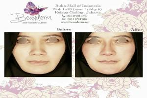 Filler Hidung / Nose Filler