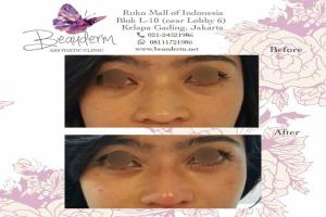 Filler Hidung / Nose Filler