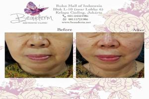 Tarik Benang (Threadlift)