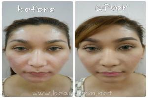 Smile Line Filler