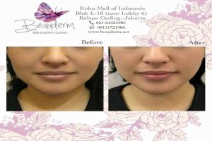 Chin Augmentation / Filler Dagu