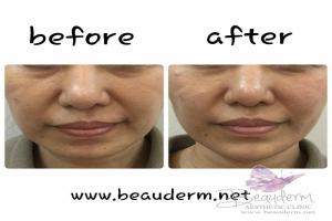 Chin Augmentation / Filler Dagu