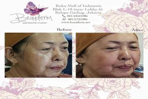 Mid Face Filler
