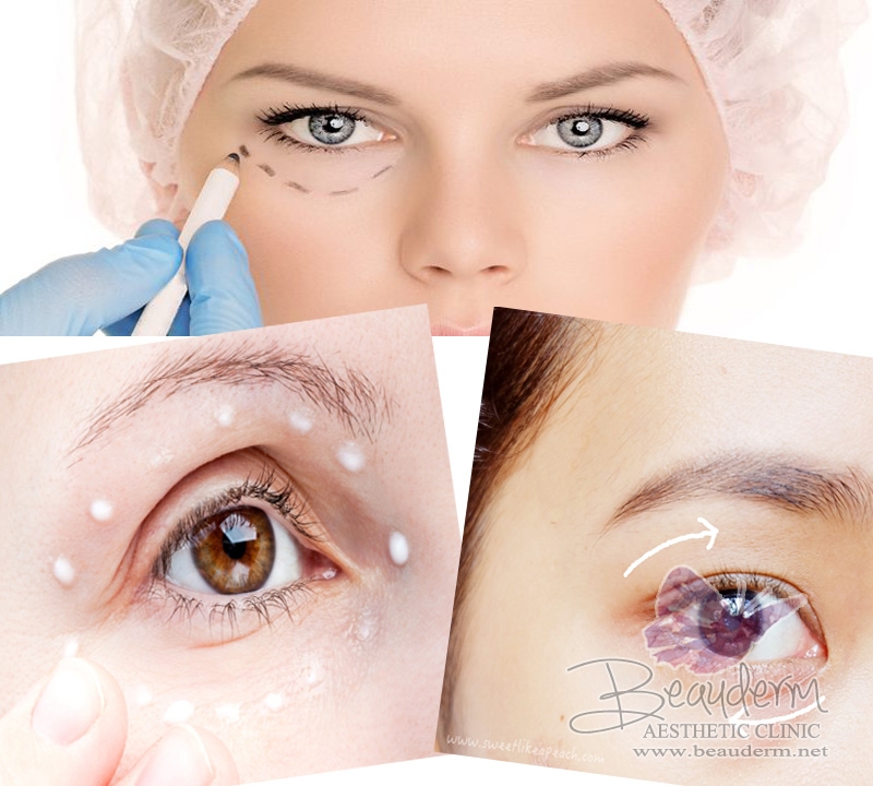Terlihat Makin Menarik & Bebas Kantung Mata (Eye Bag)