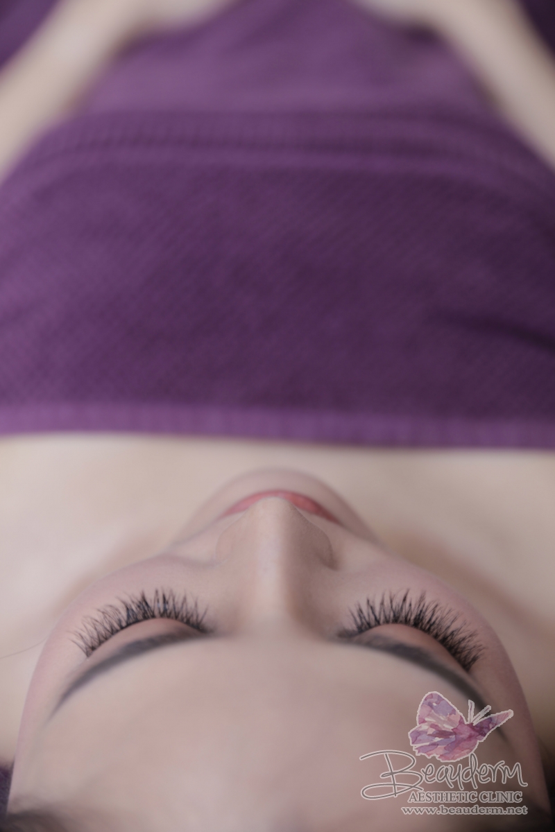 Body Threadlift