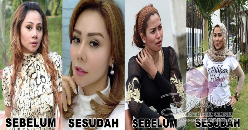 Cantikan Mana? Perubahan Pada 6 Artis Sebelum Dan Sesudah Di Filler