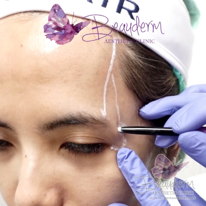 Mengurangi Memperbaiki Kerutan Area Pelipis Cekung (Proses Suntik Filler Temporal)