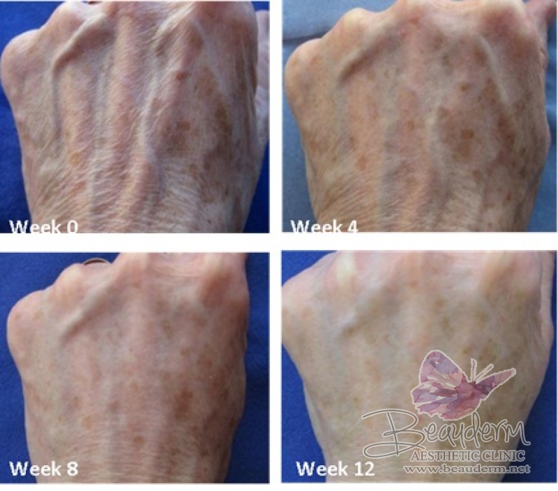 Perawatan Peremajaan Kulit (Skin Rejuvenation) Agar Tampak Awet Muda