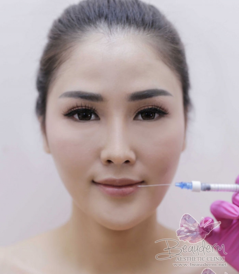 Lips Augmentation