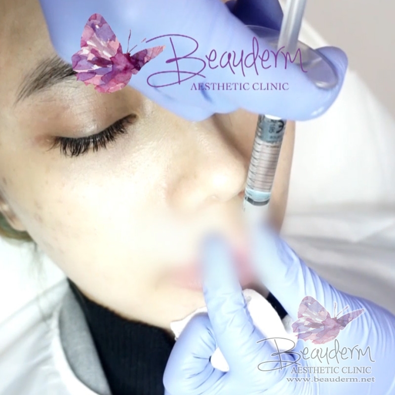 Suntik Filler Mengatasi Keriput Pada Area Bibir