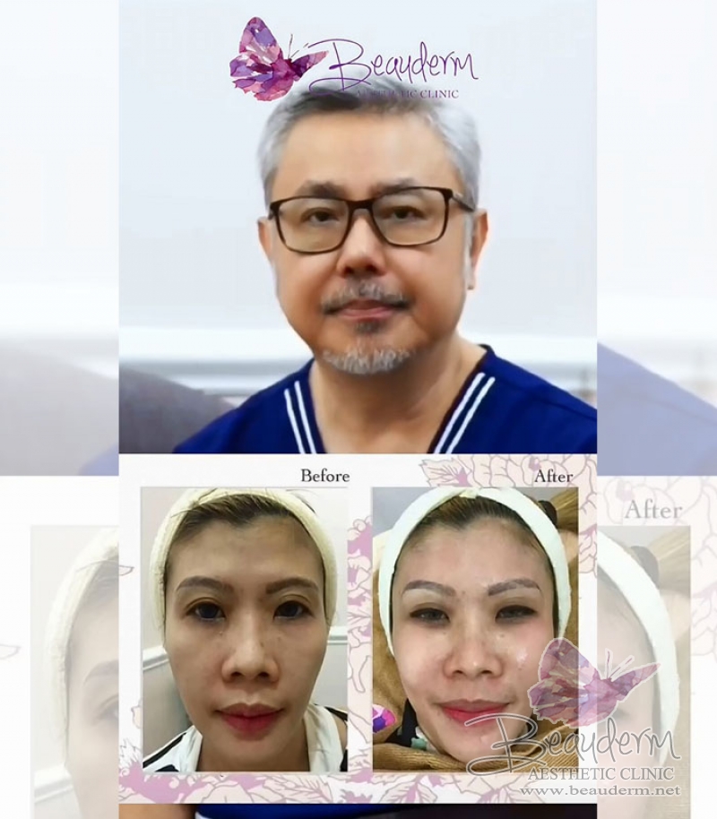 Skinbooster Memperbaiki Struktur dan Fungsi Kulit