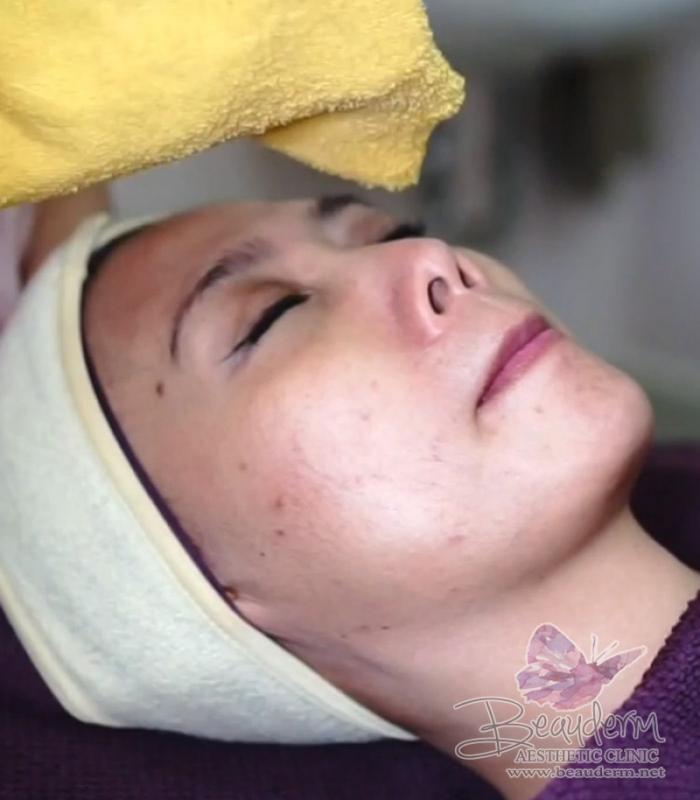 Ozone Jet Peel Facial