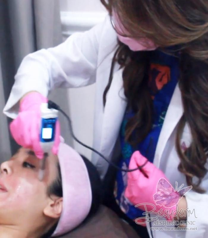 Perawatan Microneedling Untuk Kulit Wajah