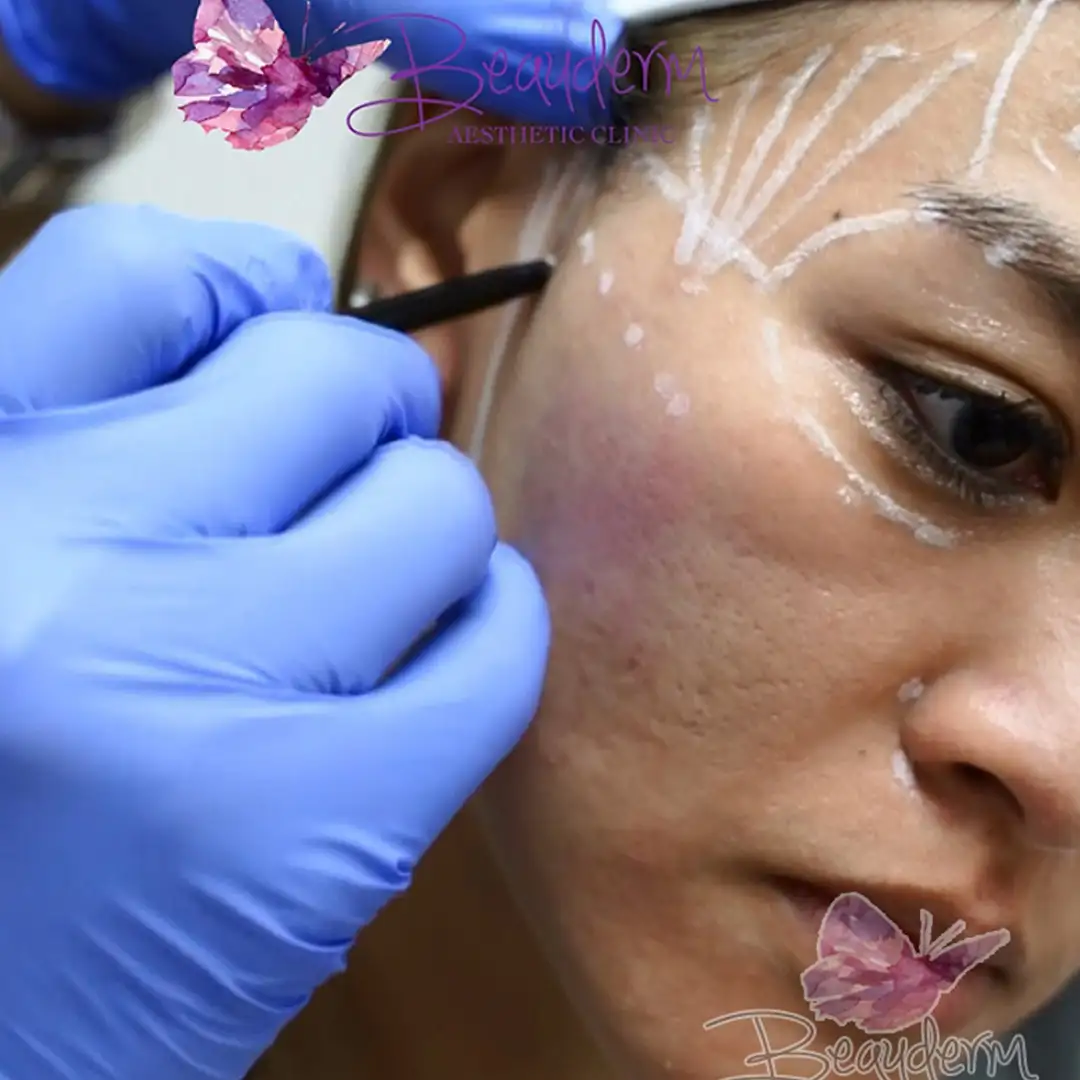 Filler Area Belakang Pipi  di Depan Telinga Yang Cekung