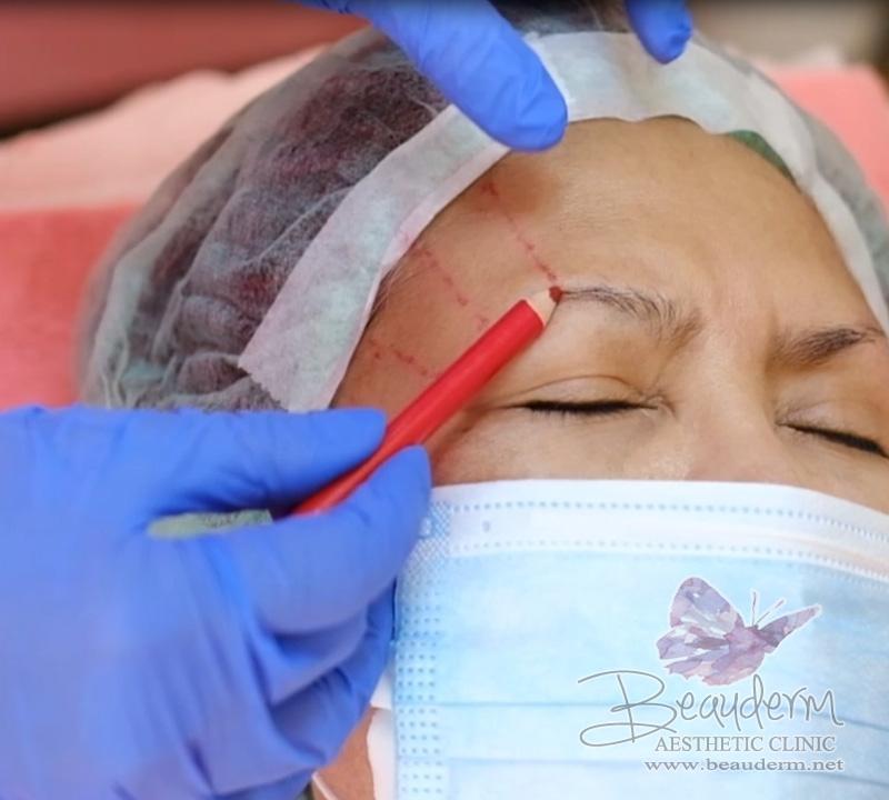 Eyebrow Thread Lifting, Metode Mengangkat Kelopak Mata Atas