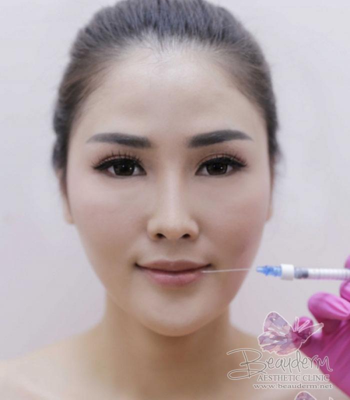 Lips Augmentation