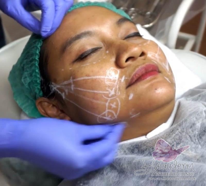 Perawatan Kecantikan Tarik Benang untuk Pipi Kendur