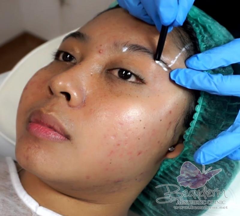 Eyebrow Lifting Thread