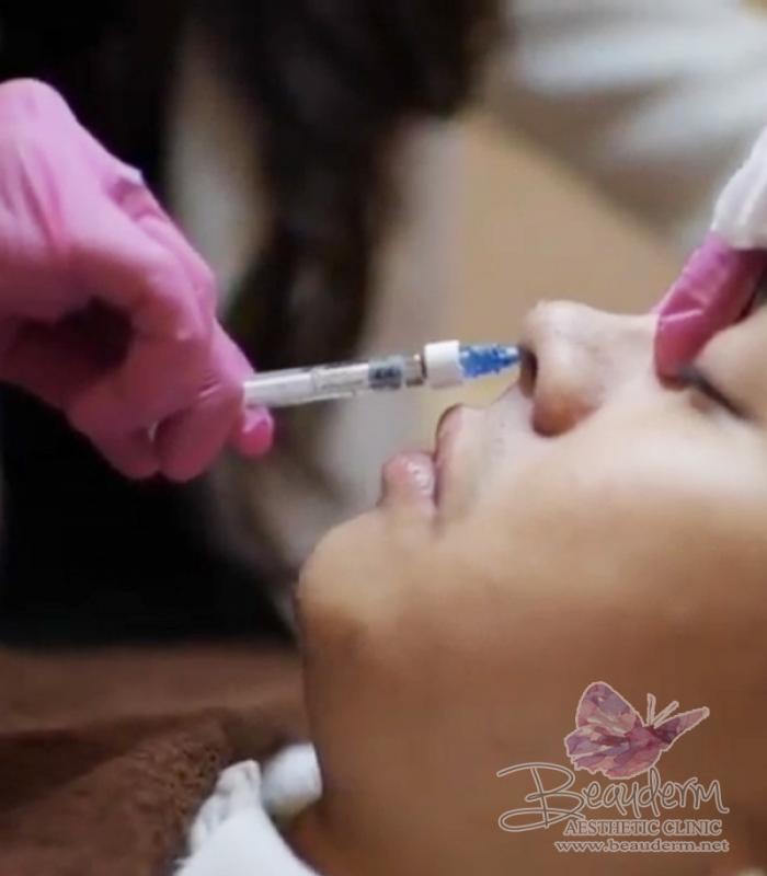 Nose Filler