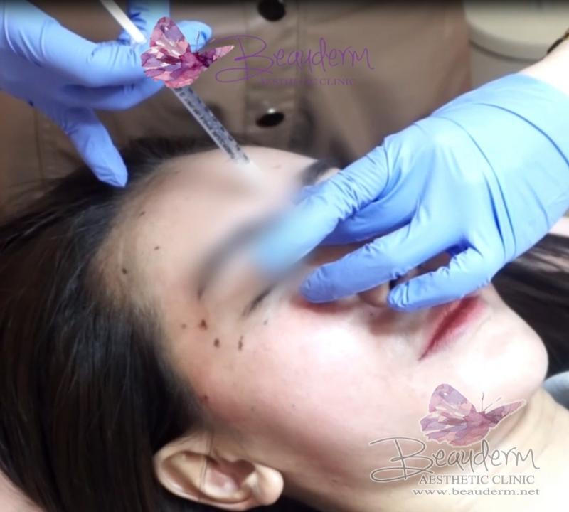 Suntik Obat Untuk Mengurangi Kerutan di Wajah