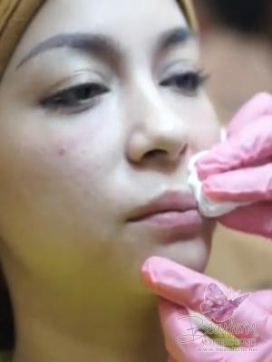 Lips Filler Treatment