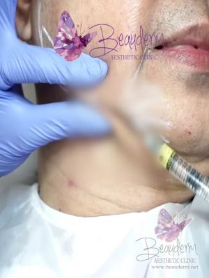 Filler Garis Rahang Bentuk Lebih Ideal Maskulin Feminin (Jawline)