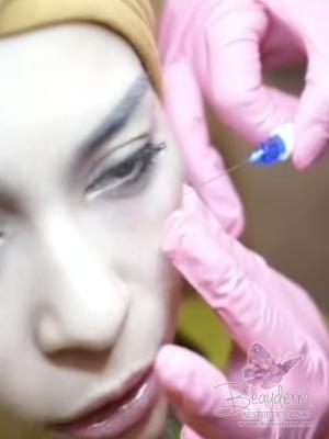 Under Eye Filler Treatment