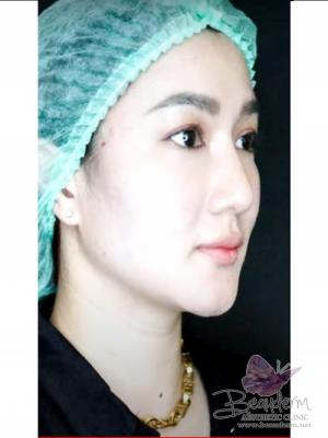 Jenis Benang yang Tepat, Perawatan Tarik Benang (Threadlift)