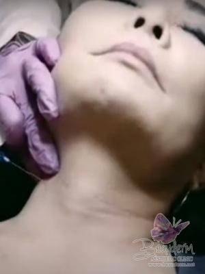 Neck Rejuvenation