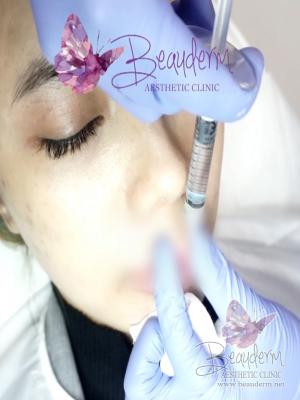 Suntik Filler Mengatasi Keriput Pada Area Bibir