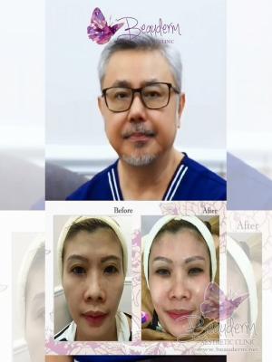 Skinbooster Memperbaiki Struktur dan Fungsi Kulit
