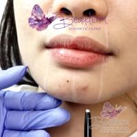 Augmentasi Chin Filler Memperbaiki Bentuk Ukuran Dagu